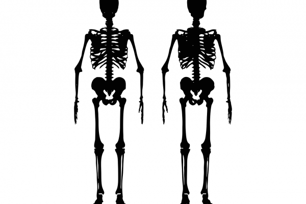 Ketahui Penyakit Osteoporosis, Gejala, dan Cara Mengobatinya penyakit osteoporosis